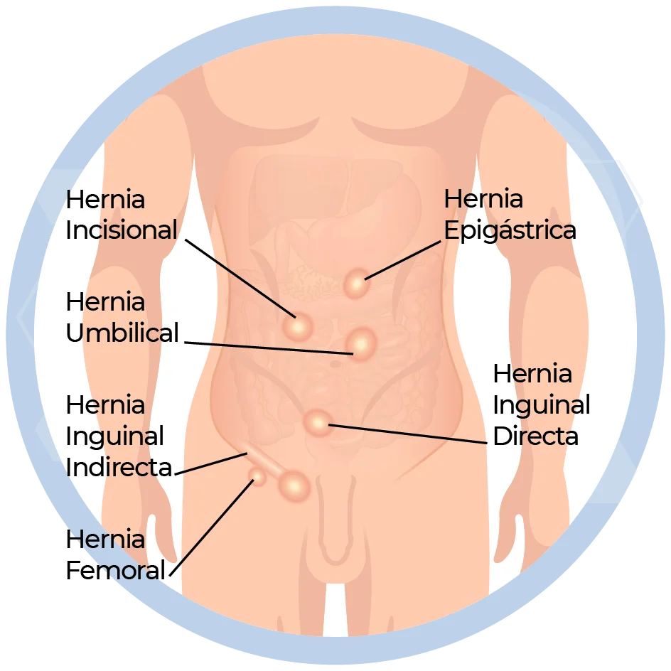cirugias hernias dr alban.png